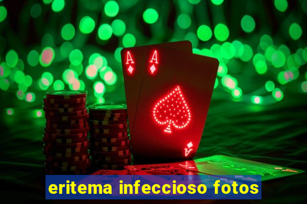 eritema infeccioso fotos